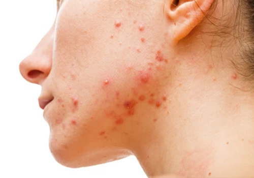 Acne & Acne Scar Treatment