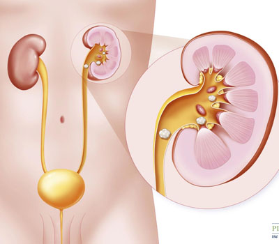 Kidney Stone Treatment