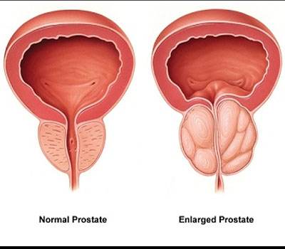 Varicocele Treatment